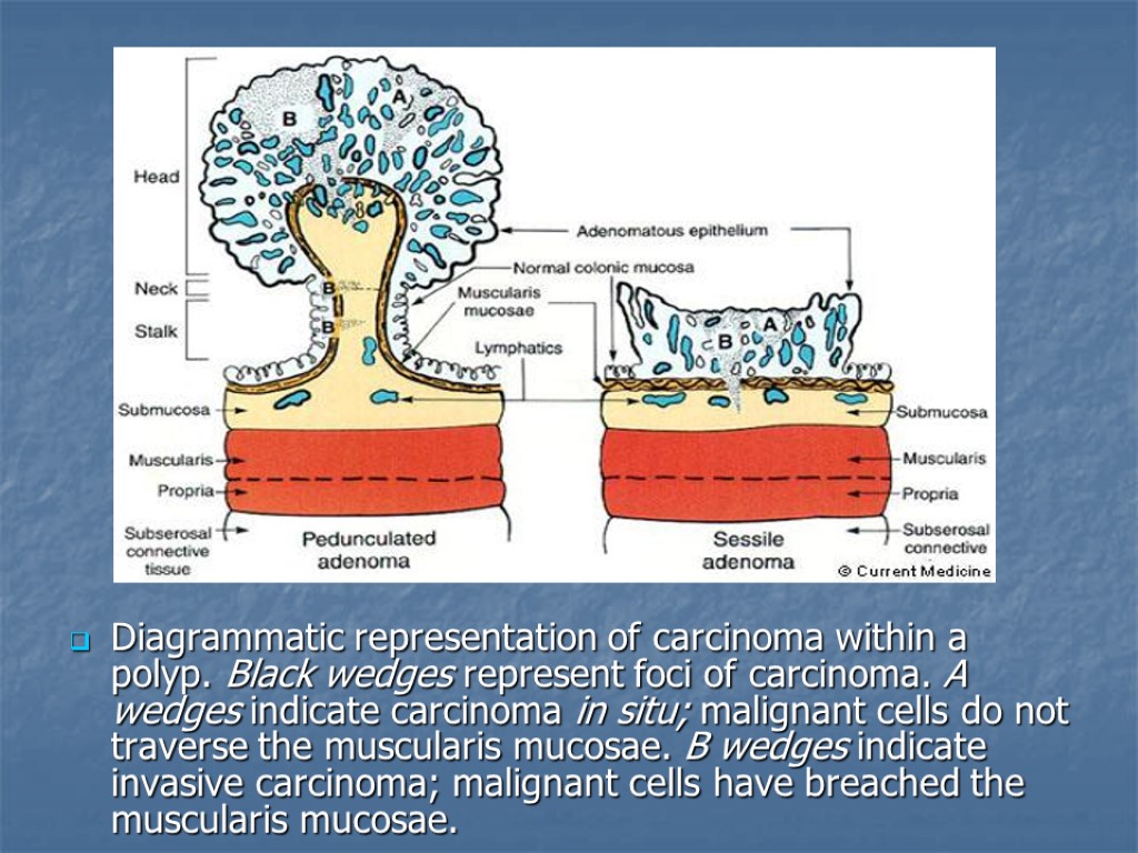 Diagrammatic representation of carcinoma within a polyp. Black wedges represent foci of carcinoma. A